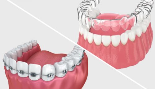 Invisalign vs Braces – David C. Montz DDS, PA & Associates – Family,  Cosmetic and Implant Dentistry