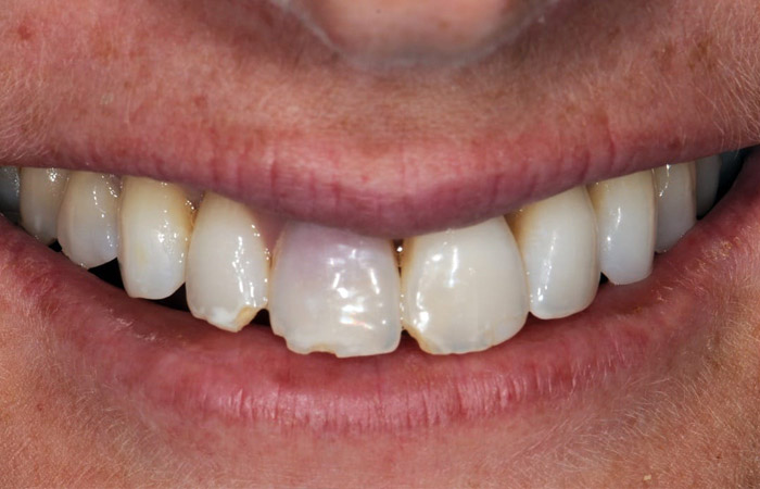 West Aurora IL Dentist, Fractured Tooth Repair